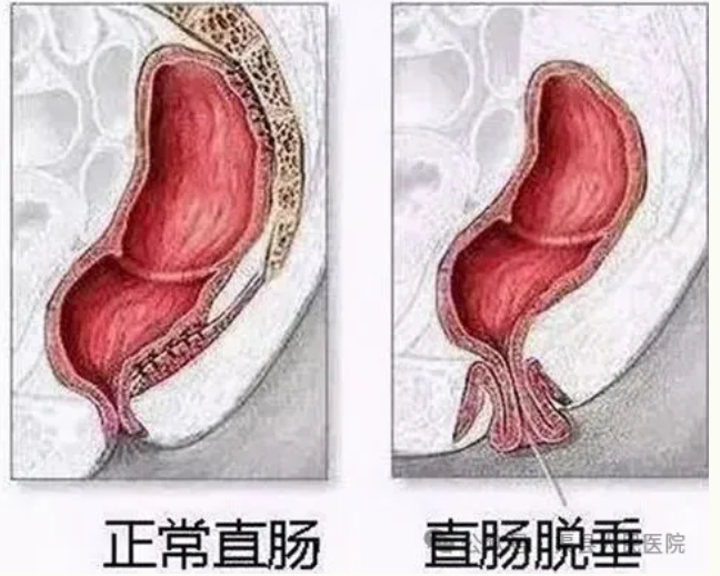 【特色医疗】直肠脱垂患者不…